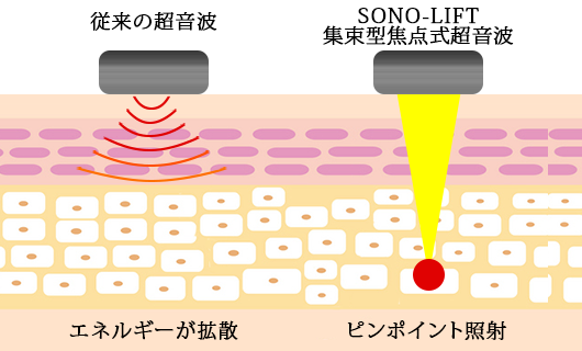従来の超音波はエネルギーが拡散するのに対してSONO-LIFT収束型焦点式超音波はピンポイントに照射します
